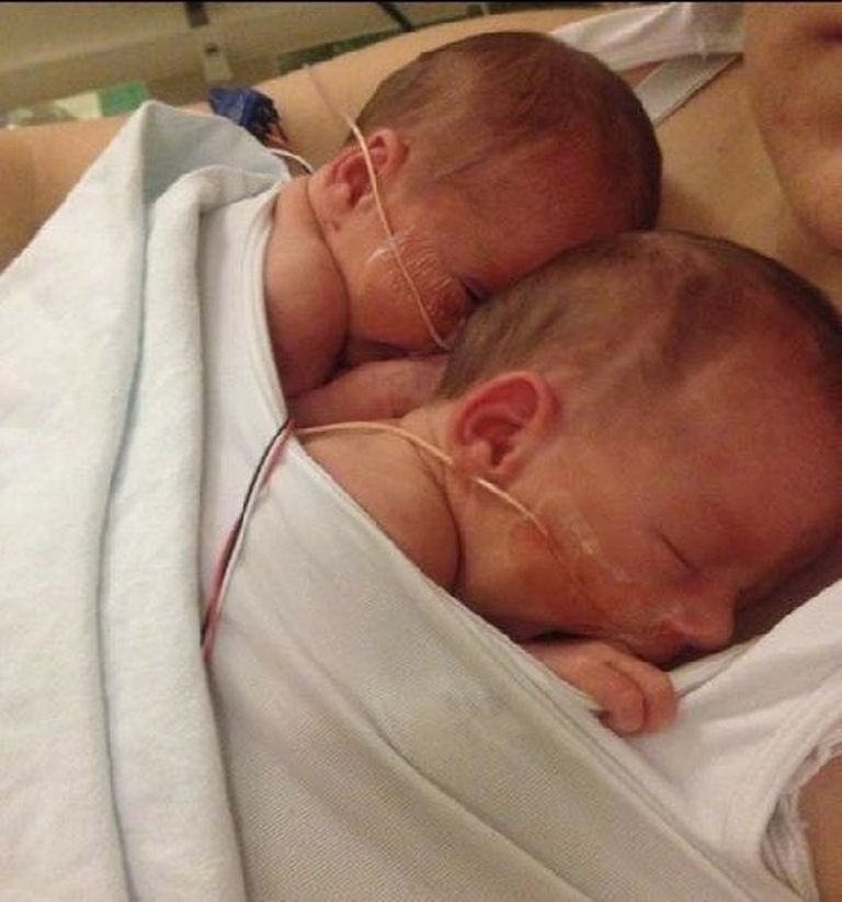 Jenna ja Jillian pärast sündi. Foto: