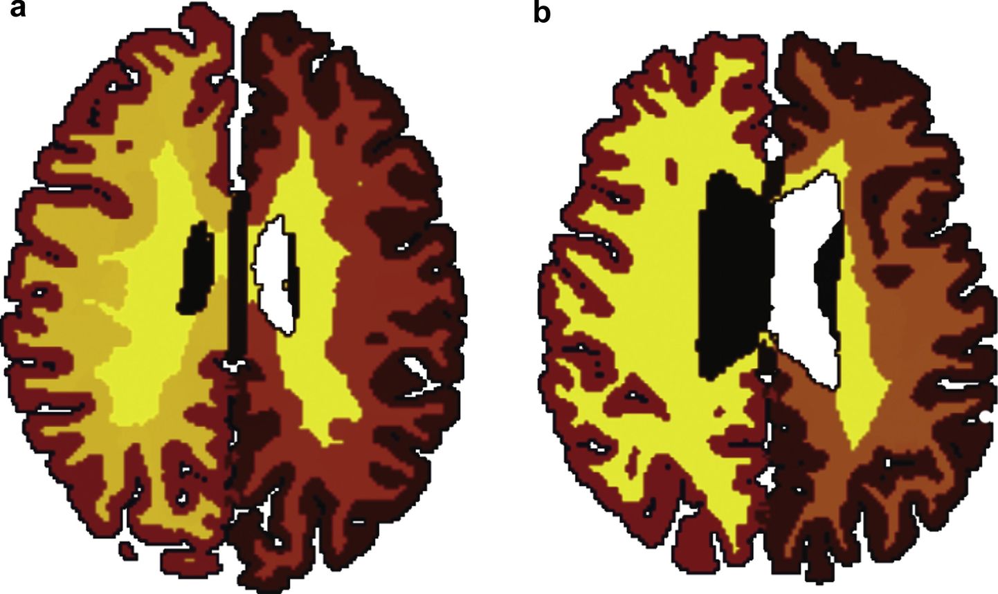 Valgeolluse vähenemine (a) kõhna 56-aastase inimese ajus ja (b) rasvunud 50-aastase ajus.
