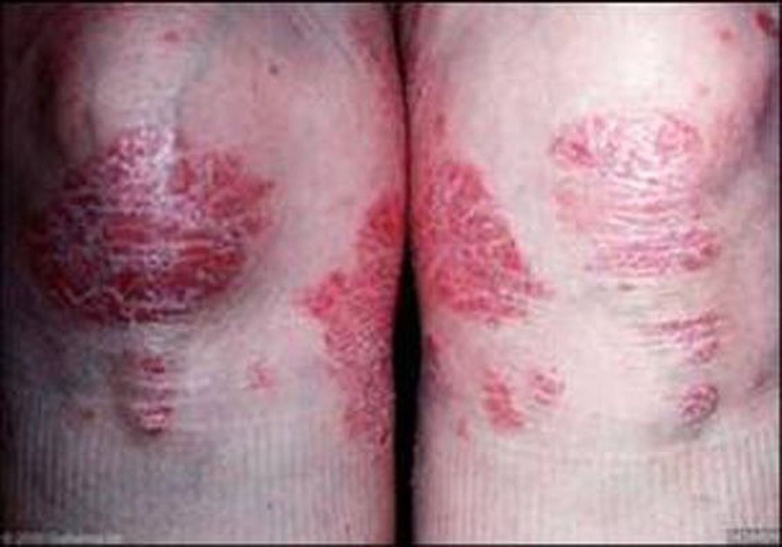 Psoriaas – pärilik nahahaigus.