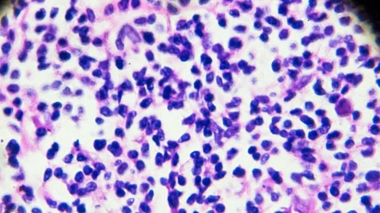 Так выглядят клетки лимфомы Ходжкина