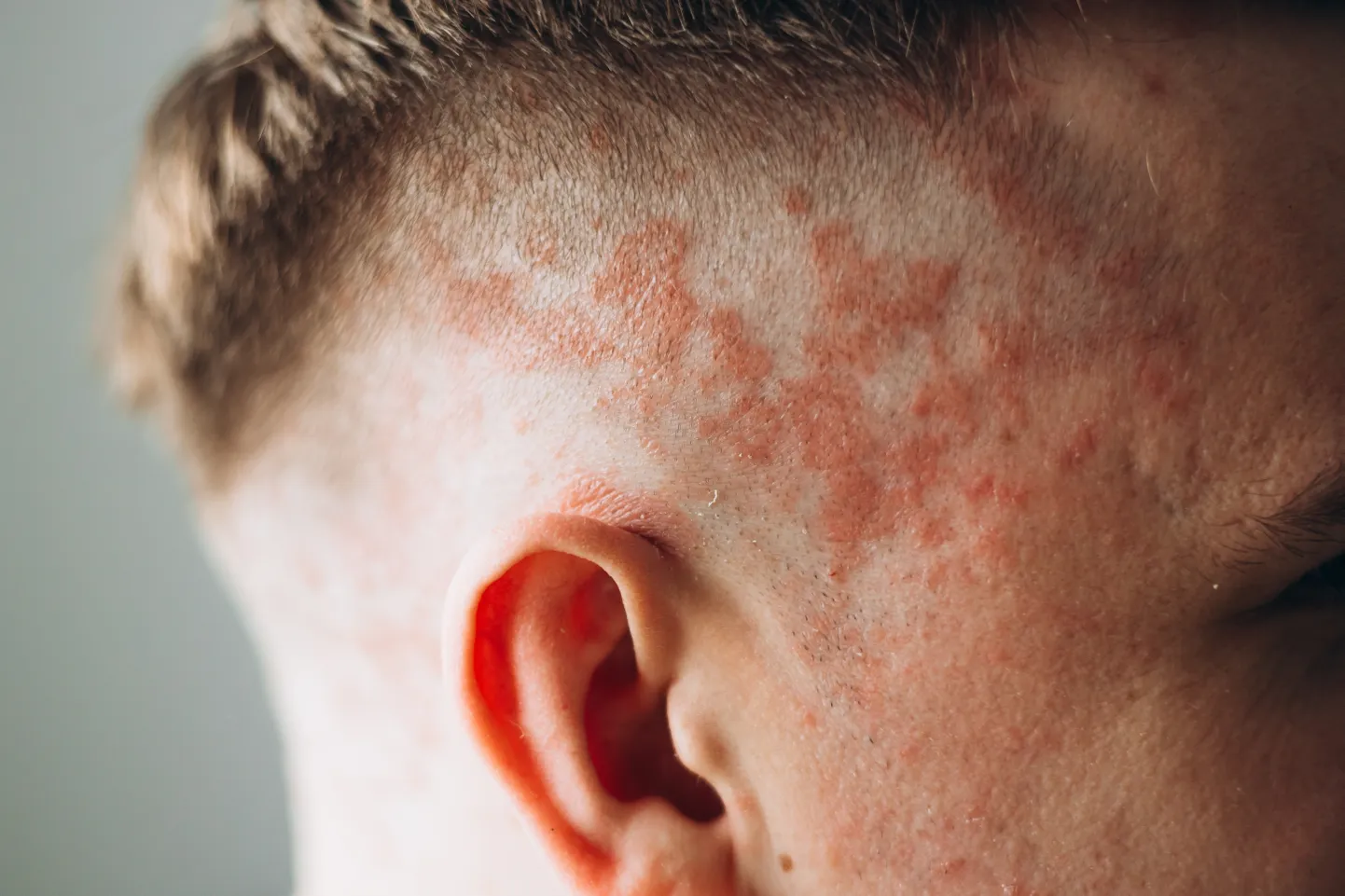 Psoriaas