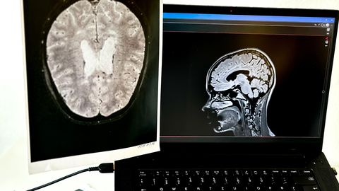 В Латвии растет число людей с рассеянным склерозом