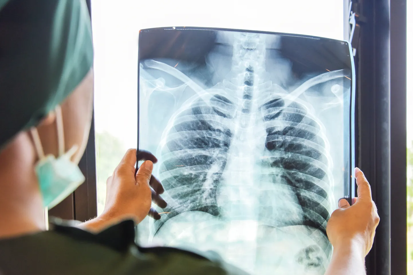 Plaušu rentgens. Ilustratīvs foto