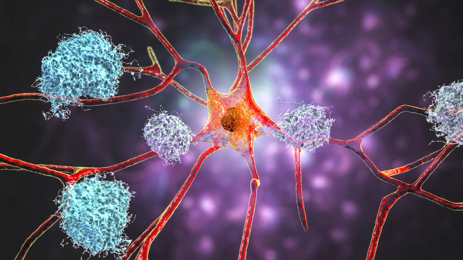 Neuronite ühendusi takistavad ajus kuhjuvad amüloidvalgud.
