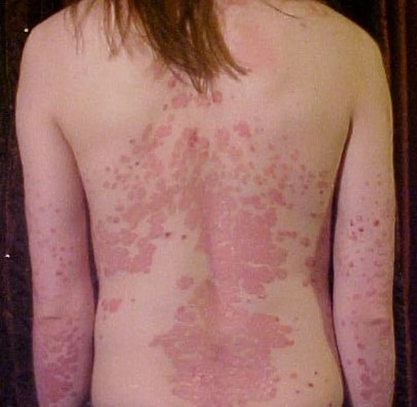 Pildil on näha psoriaasi seljal..