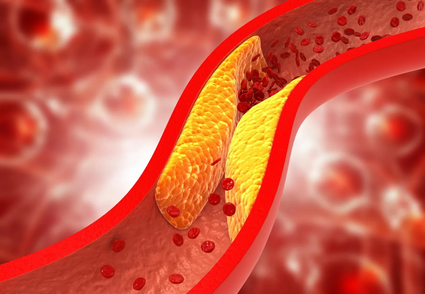 Kõrge LDL- ehk halb kolesterool on üks peamine südamelihase infarkti ja insuldi riskitegur.