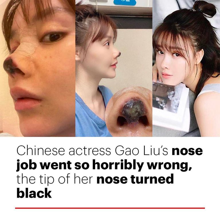 Gao Liu untsu läinud ninalõikus