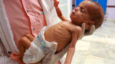 Ravikeskuse töötaja hoiab alatoitumuse all kannatavat Jeemeni last põhjas Hajjahi provintsis 5. juulil, 2020. aastal. ÜRO nimetab Jeemeni sõda maailma halveimaks humanitaarkriisiks. Miljonid Jeemeni lapsed nälgivad, kuna riik ei saa abi. Ravikeskuse töötaja hoiab alatoitumuse all kannatavat Jeemeni last põhjas Hajjahi provintsis 5. juulil, 2020. aastal. ÜRO nimetab Jeemeni sõda maailma halveimaks humanitaarkriisiks. Miljonid Jeemeni lapsed nälgivad, kuna riik ei saa abi.