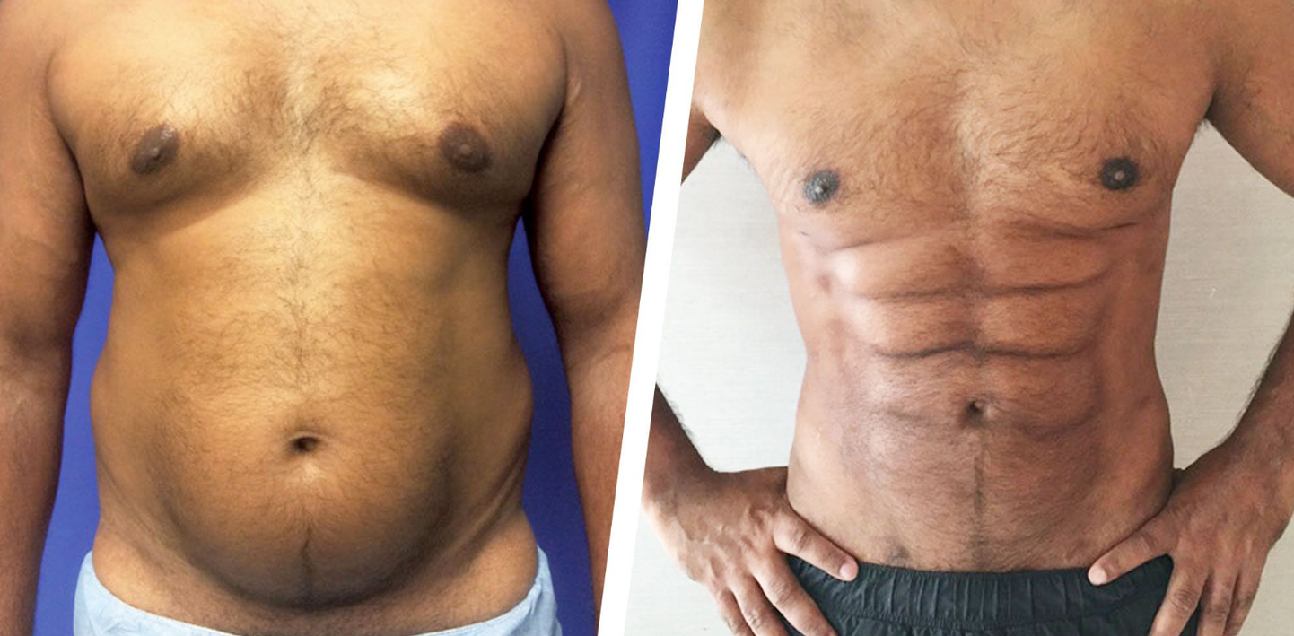 Uut tüüpi rasvaimu protseduur - vasakul esialgne keha, paremal kirurgilise sekkumisega saavutatud tulemus.