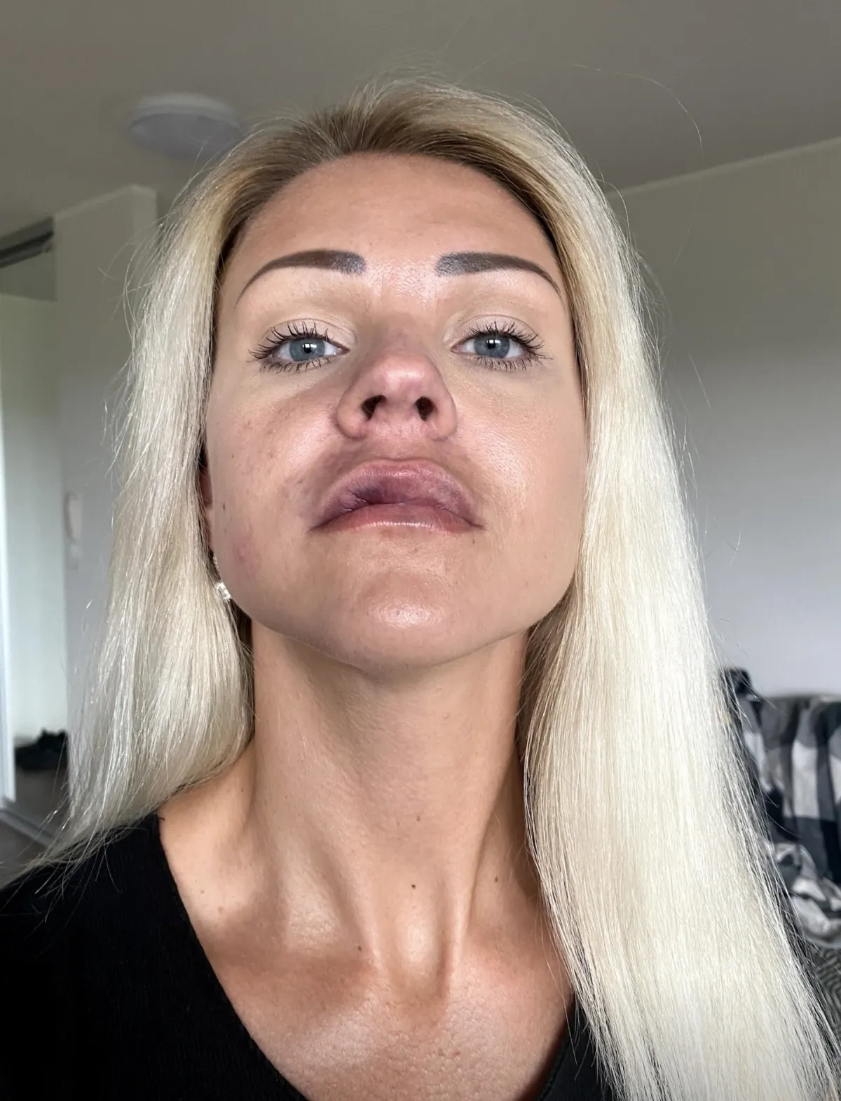 Marlee peale ebaõnnestunud huulte täitesüste.