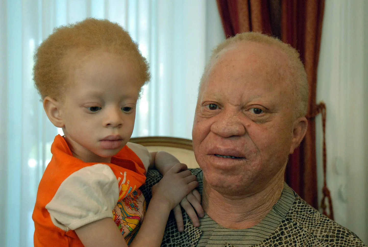 Aafrika riikides jätkuvad albiinode tapmised