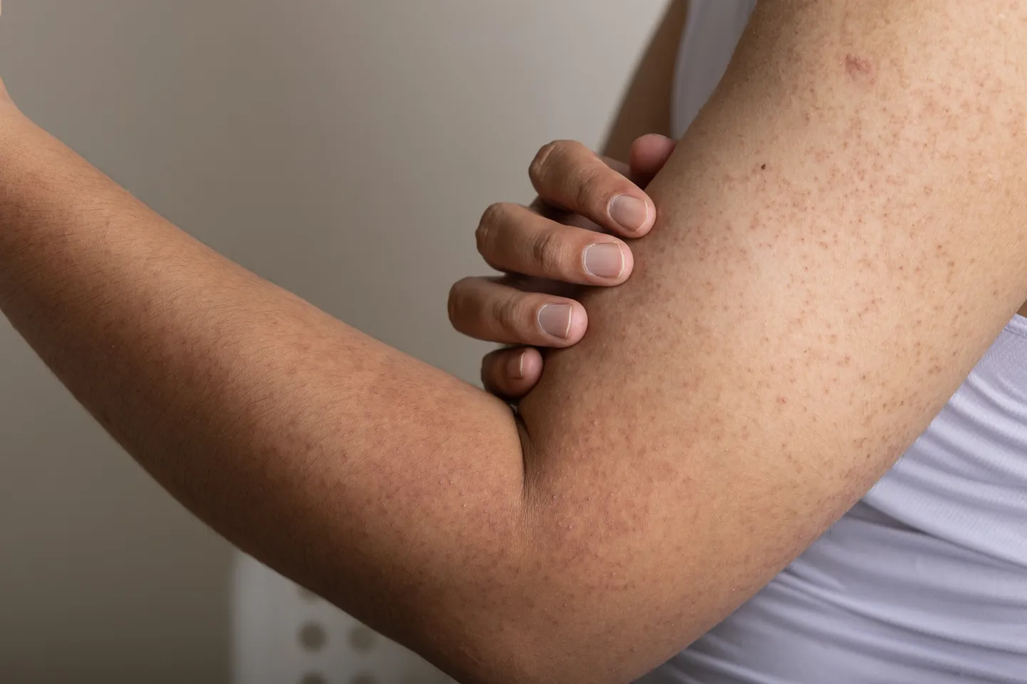Keratosis pilarist peetakse sageli naha tavaliseks seisundiks. Seda ei saa ravida ega ära hoida. Kuid võite seda ravida niisutajate ja retseptikreemidega, et parandada naha välimust.