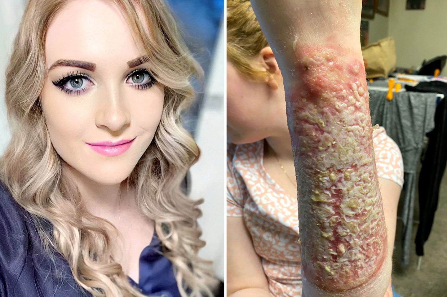 Jenna Allen (L) and her arm (R).  A venomous spider bite has left a mum with $1.3k a WEEK medical bill, unable to hug her kids and at risk of cancer.  See SWNS story SWSMspider.  Jenna Allen, 28, was volunteering in her hometown, Donald, Victoria, Australia, after severe floods ravaged the area in November 2014.  She reached into a box to get a pair of shoes when she was bitten by a highly venomous Redback spider - also known as the Australian black widow - on her left arm.  Instantly her skin reacted, and Jenna had goose bumps up her left arm, stomach cramps and vomiting.  The local hospital didn’t have any antivenom and Jenna had to travel an hour to another hospital - where she was given two doses and admitted to intensive care.  Jenna was transferred to the Bendigo Hospital, Victoria, for two months where she had a skin graft.  This worked for a year but then a mosquito bite sized pinprick resurfaced which burst.  Her unhealed wound now causes her horrendous pain and has to be constantly bandaged.  The dance teacher is petrified she will get cancer as medics have detected pre-cancerous cells in the wound.  Jenna has health insurance provided by medicare but because her condition is so exceptional, not all of the sky-high costs aren't covered.