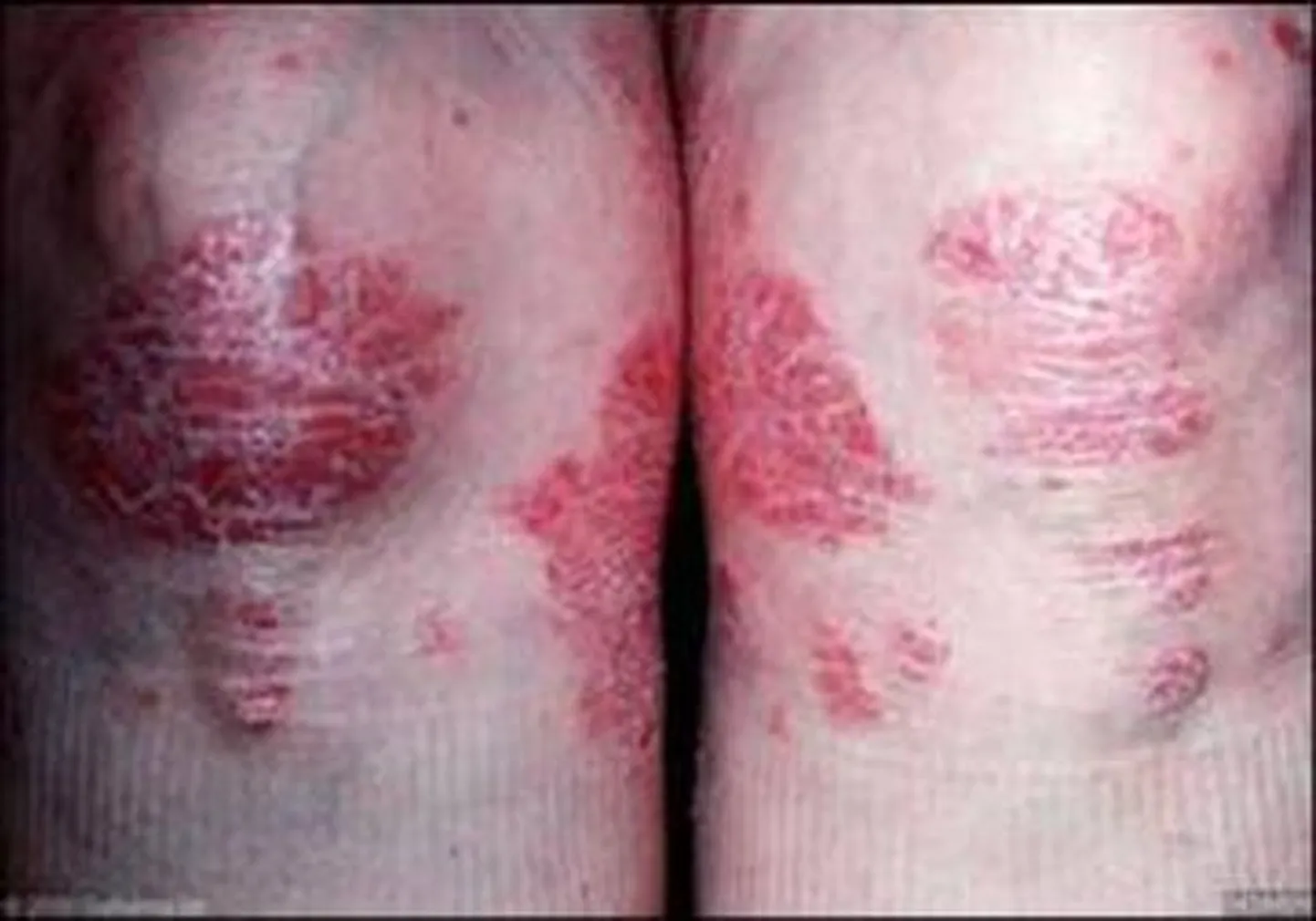Psoriaas – pärilik nahahaigus.