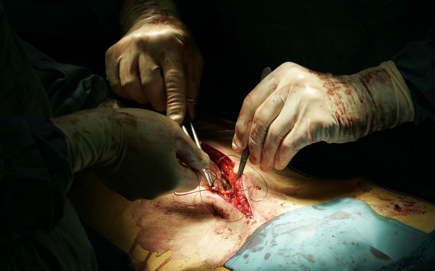 Kirurgid eemaldasid patsiendilt 42-kilogrammise kasvaja