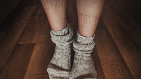 Sokijäljed jalal võivad viidata tõsisele terviseseisundile