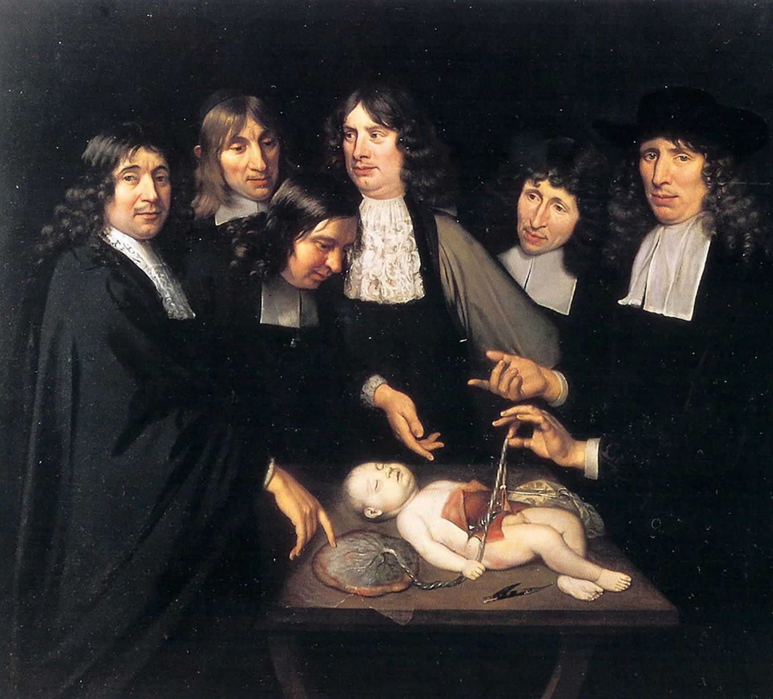TOHTRID JA HABEMEAJAJAD: 17. sajandi teise poole olustikust ja meditsiinist annab aimu fragment Jan van Necki (1638 – 1731) maalist “Dr Frederick Ruyschi anatoomiatund” (1683). Kaabuga tohter demonstreerib enneaegselt sündinud lapse nabanööri.