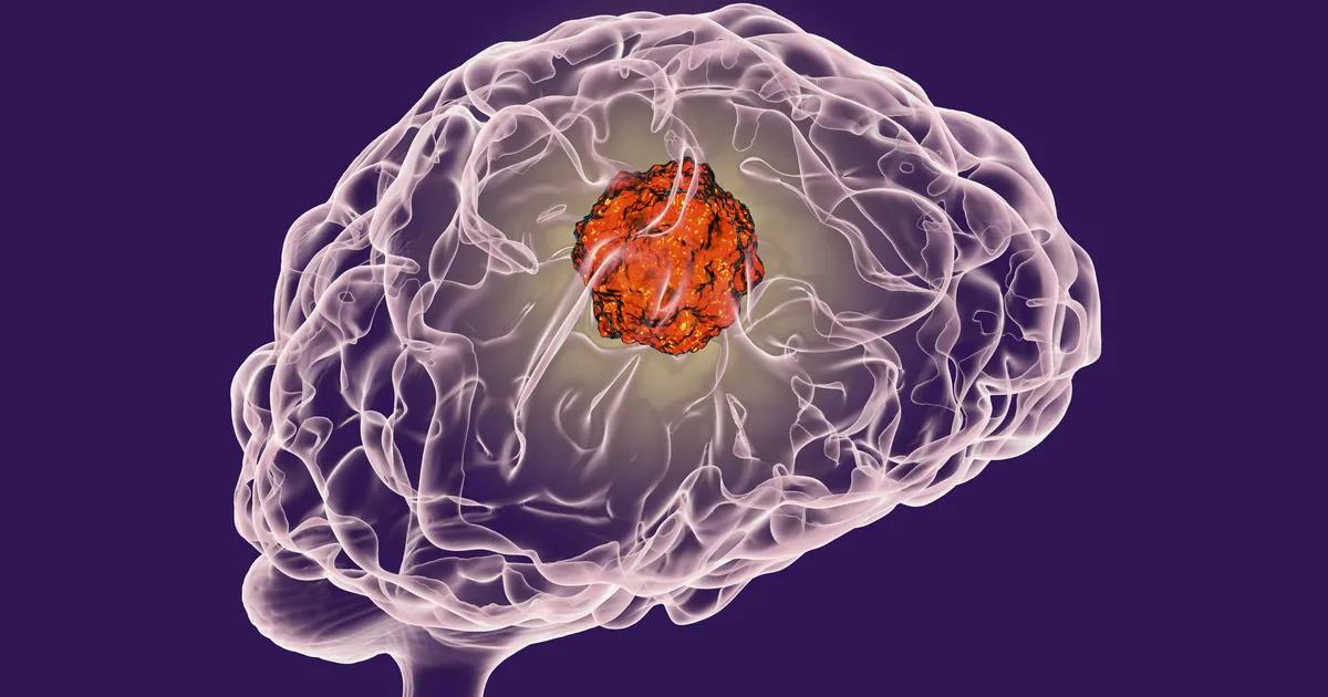 Urme de craniu – Egiptenii antici tratau cancerul la creier chirurgical?