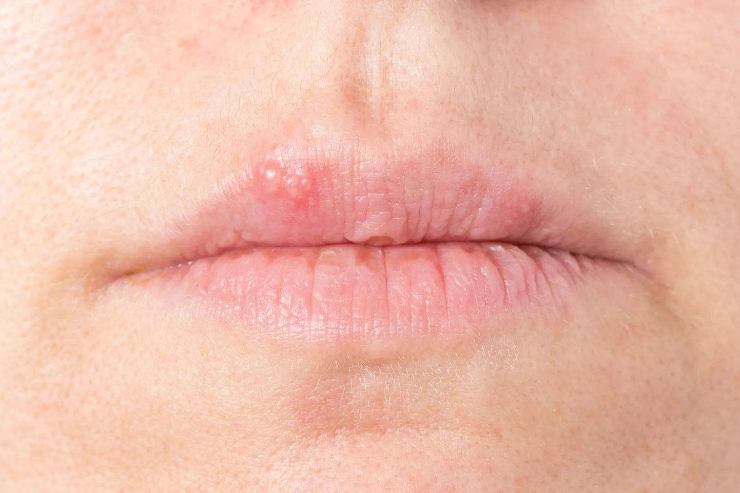 Huuleherpes kipub korduma.