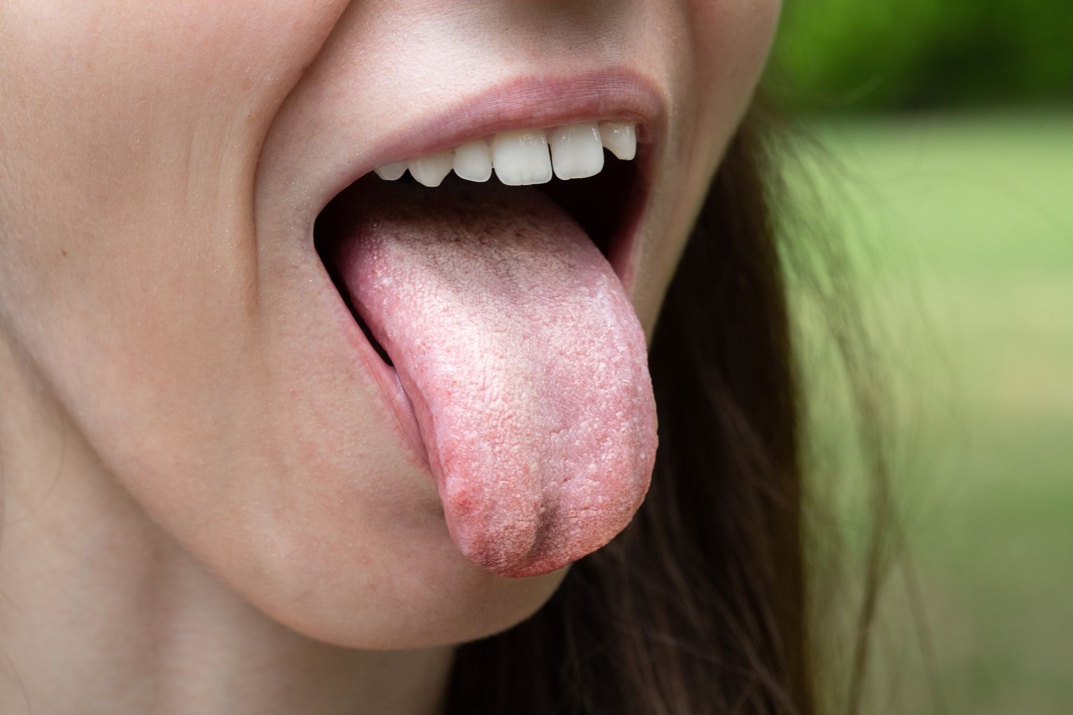 Разрастание Candida вызывает кандидоз. Кандидоз полости рта характеризуется неприятным привкусом и покраснением и жжением во рту, белым налетом на языке, покалыванием слизистых оболочек, а также может вызвать язву в уголке рта.