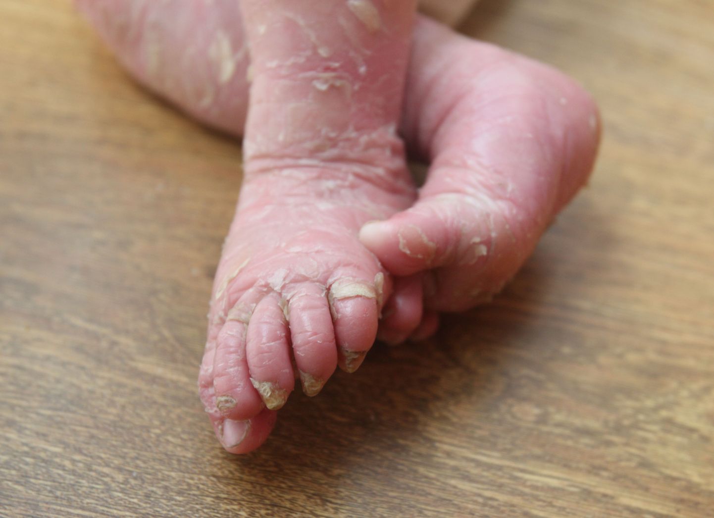 Ihtüoosihaigete laste nahk vajab pidevat kreemitamist.