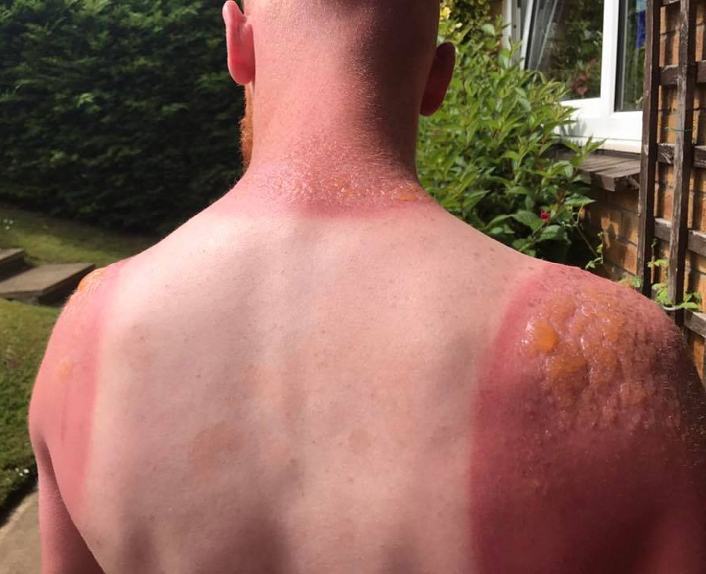 Päikesepõletus võib olla väga valus ja tekitada nahale tõsise trauma.