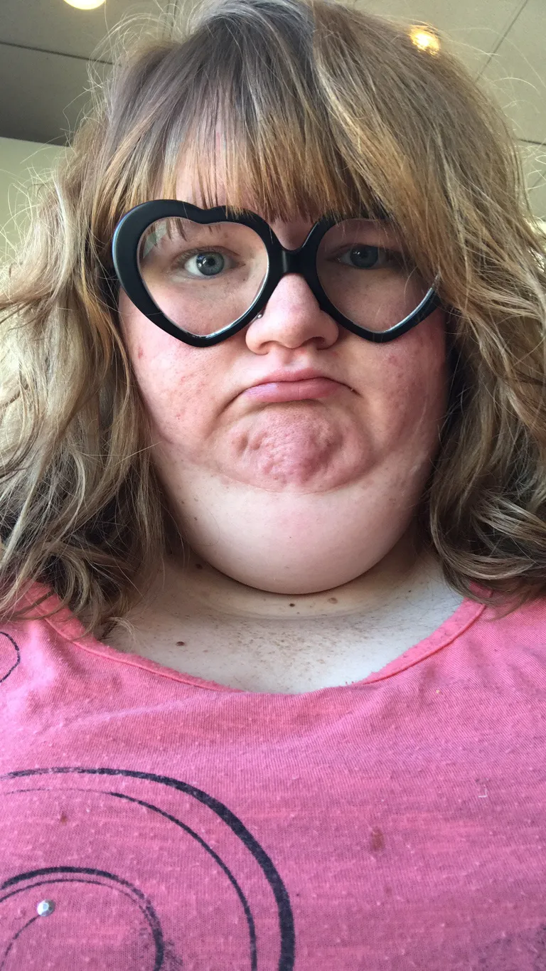 Erika Olson enne operatsiooni.