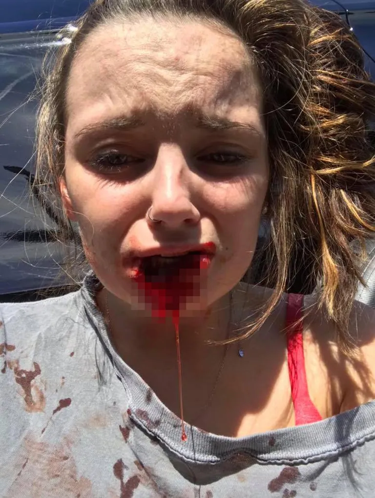Kayla Hayes pärast julma rünnakut ekskallima poolt.