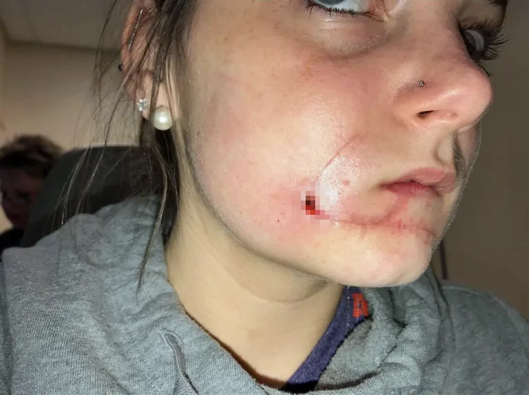 Kayla Hayes ei saa oma suud pärast rünnakut täielikult liigutada.