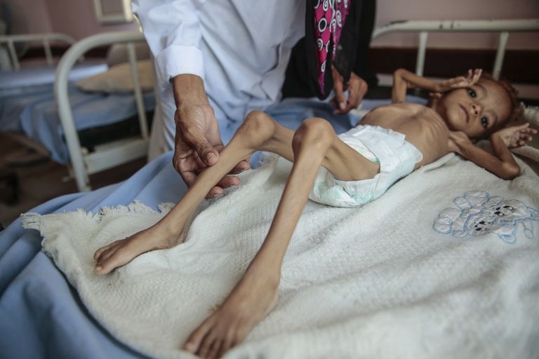 Äärmiselt alatoitunud Jeemeni poiss haiglas. 