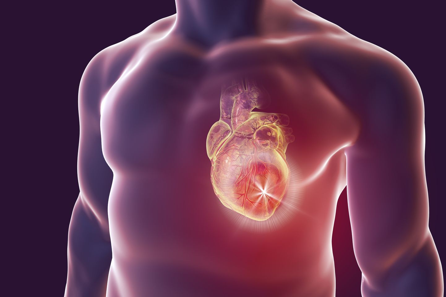 Müokardiit ehk südamelihase põletik tekib suurema tõenäosusega Covid-19 tõttu kui vaktsineerimise tõttu.