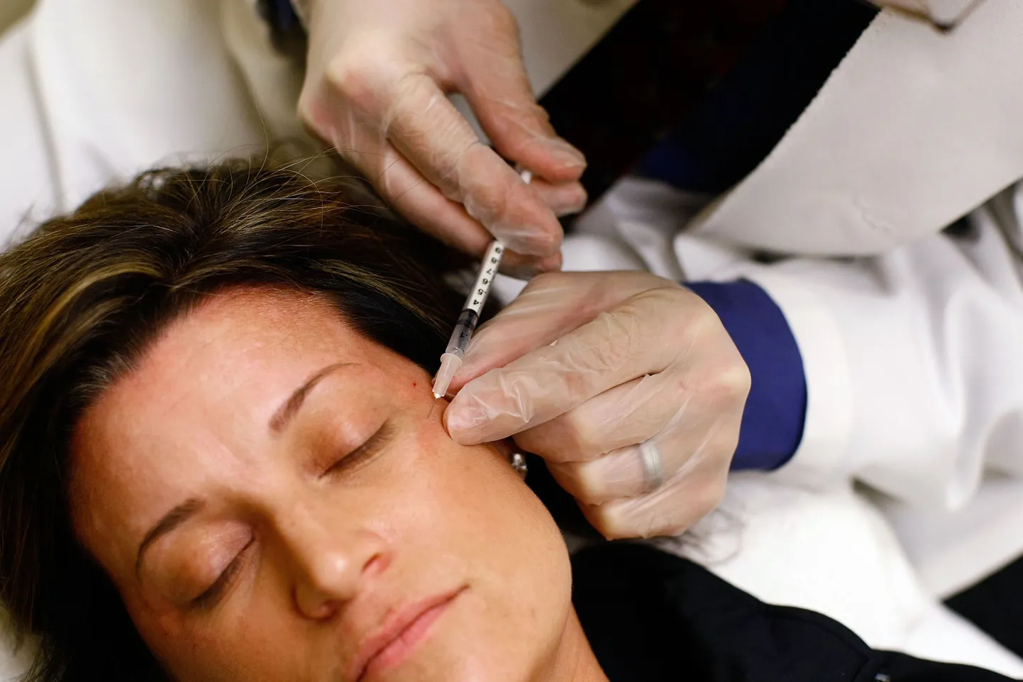 Botox aitab kiilaspäisust ravida