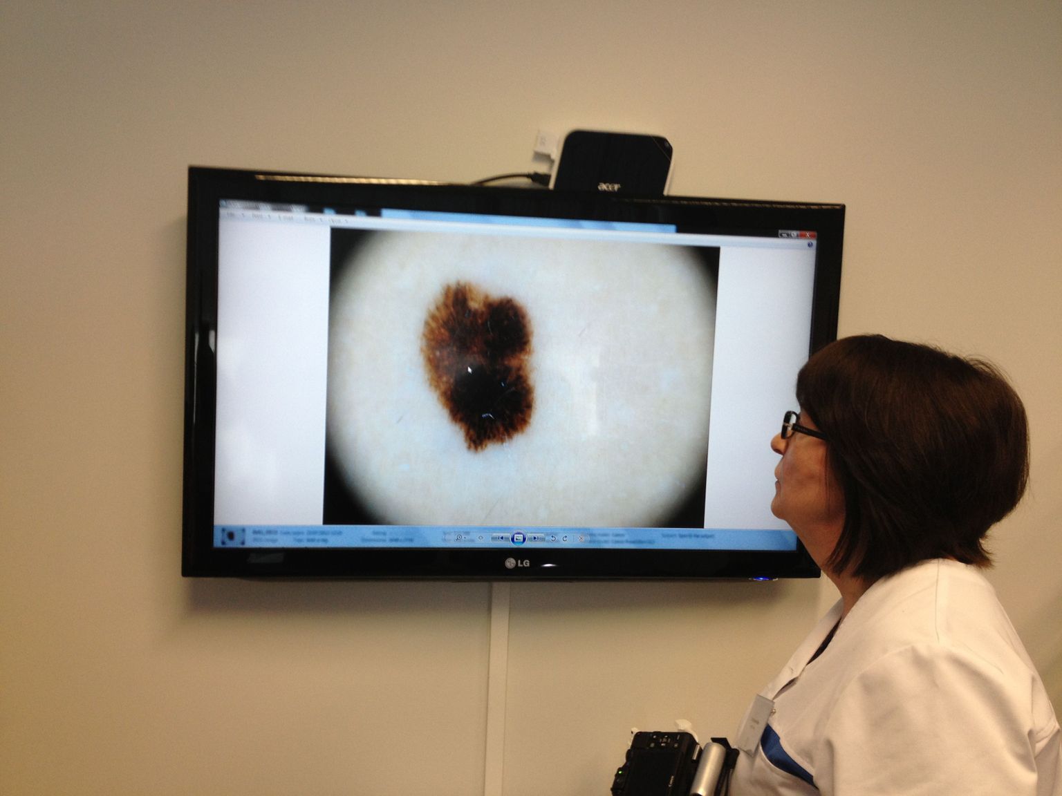 Dr Niin näitab melanoomi.