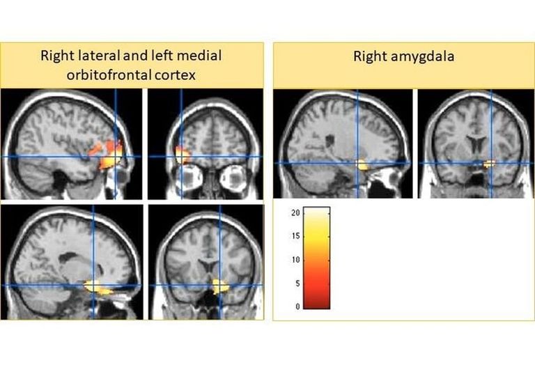 Magnetresonantstomograafia (MRT) pildid väiksematest ajustruktuuridest lastel, kes on kogenud karme kasvatusmeetodeid.