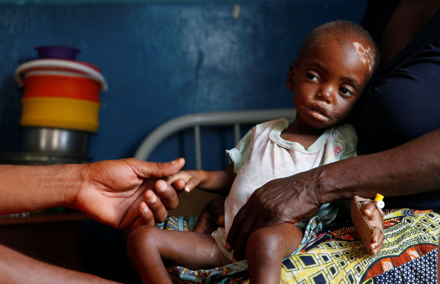 Rängas alatoitumuses 19-kuune Kaba Bitika Marie haiglas Kasai provintsis Kongo DVs.