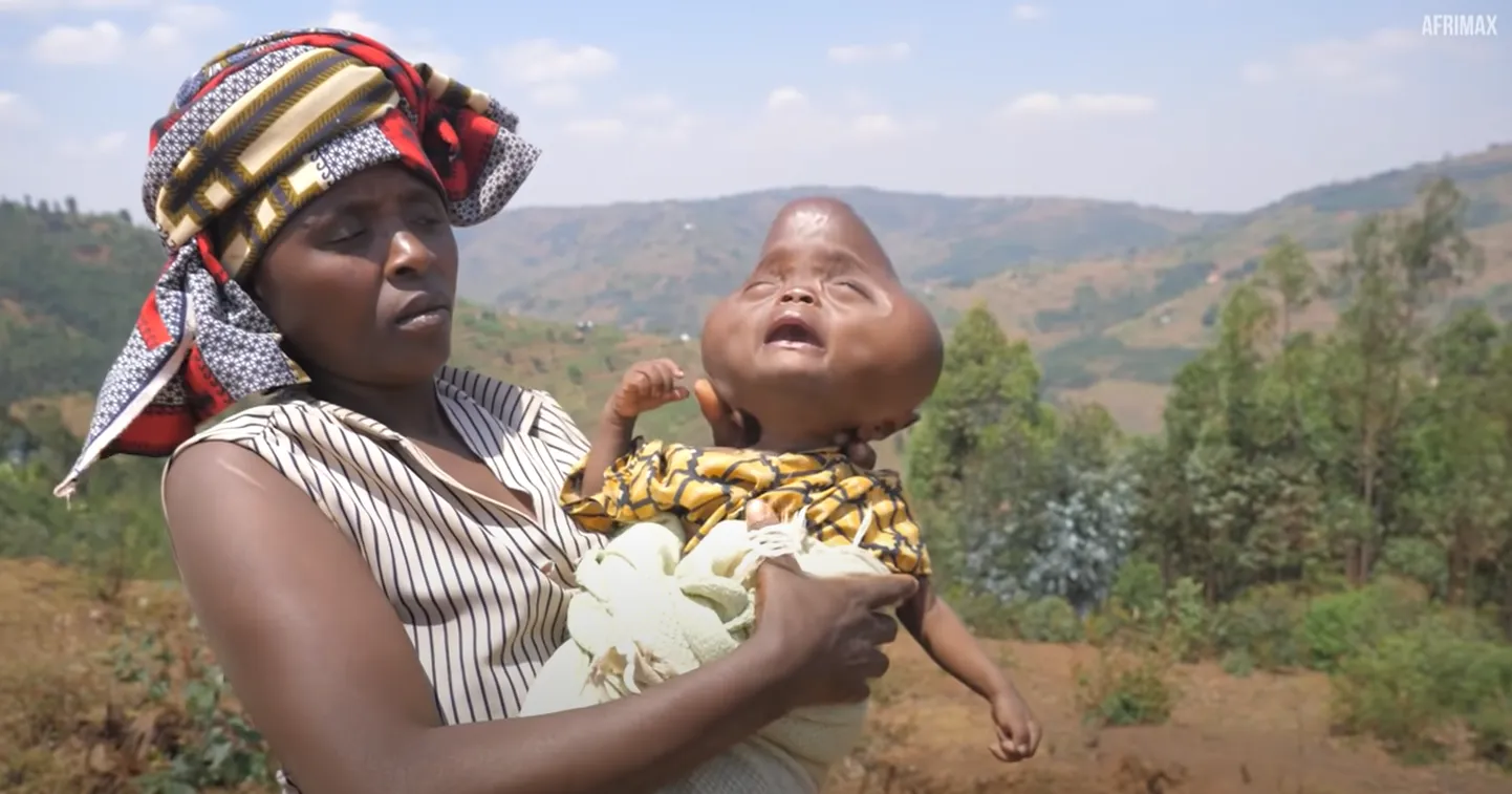 Puudega sündinud Ruanda poiss