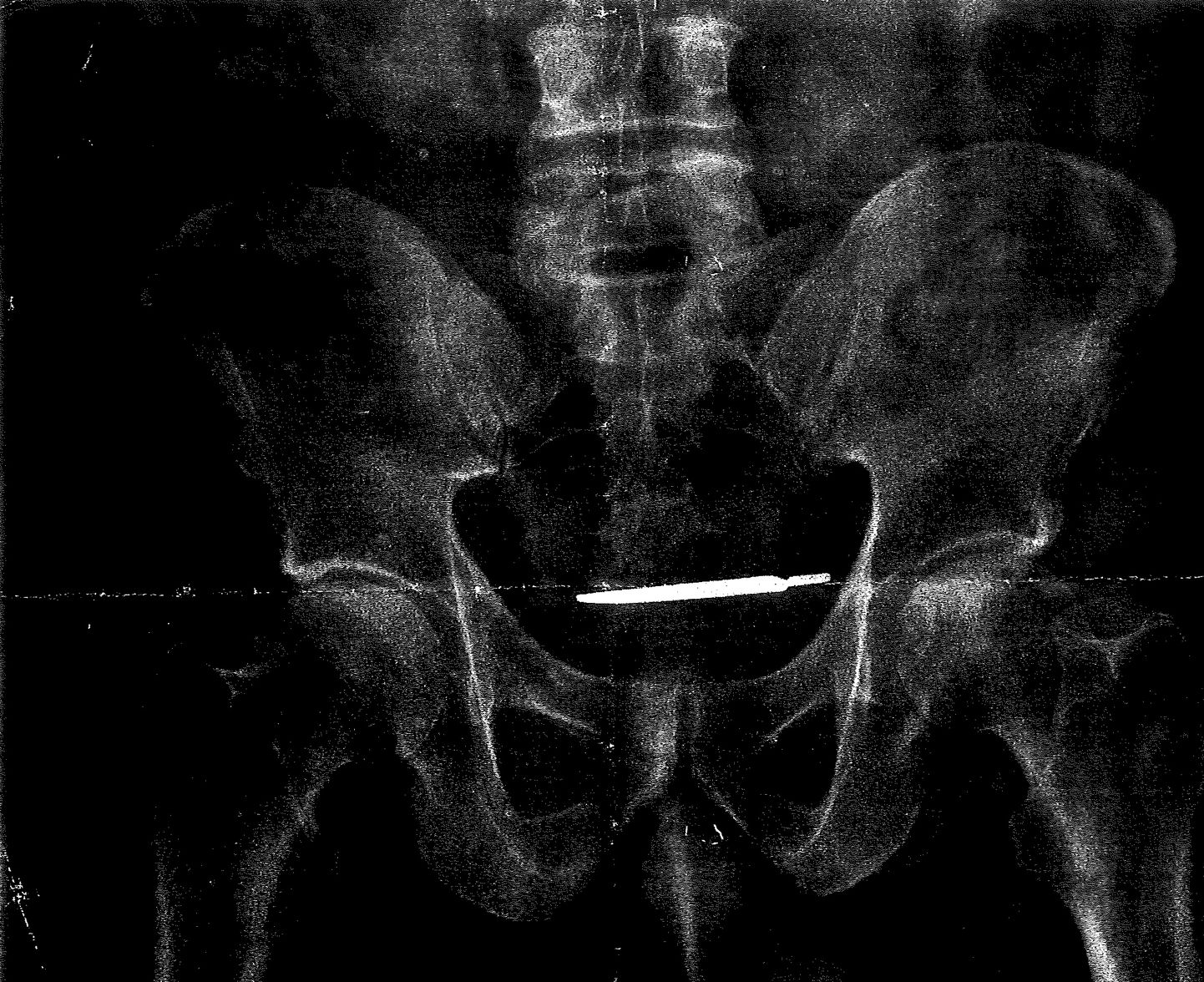 Glenford Turneri röntgenpilt, millel on näha kõhtu jäänud skalpelli.