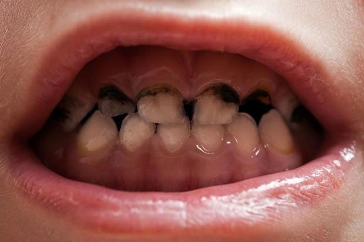 Mokatubakast kahjustatud hambad.