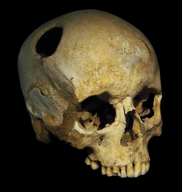Rauaaegne pealuu, milles on trepanatsiooni teel tehtud auk.