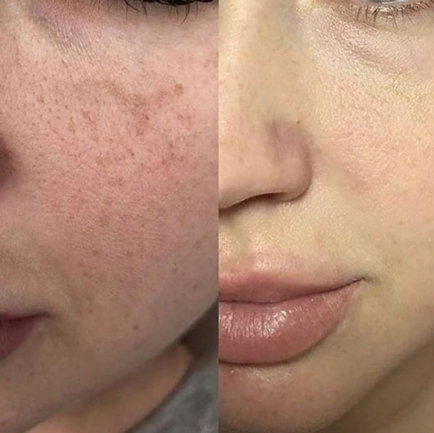 Процедура baby glow.