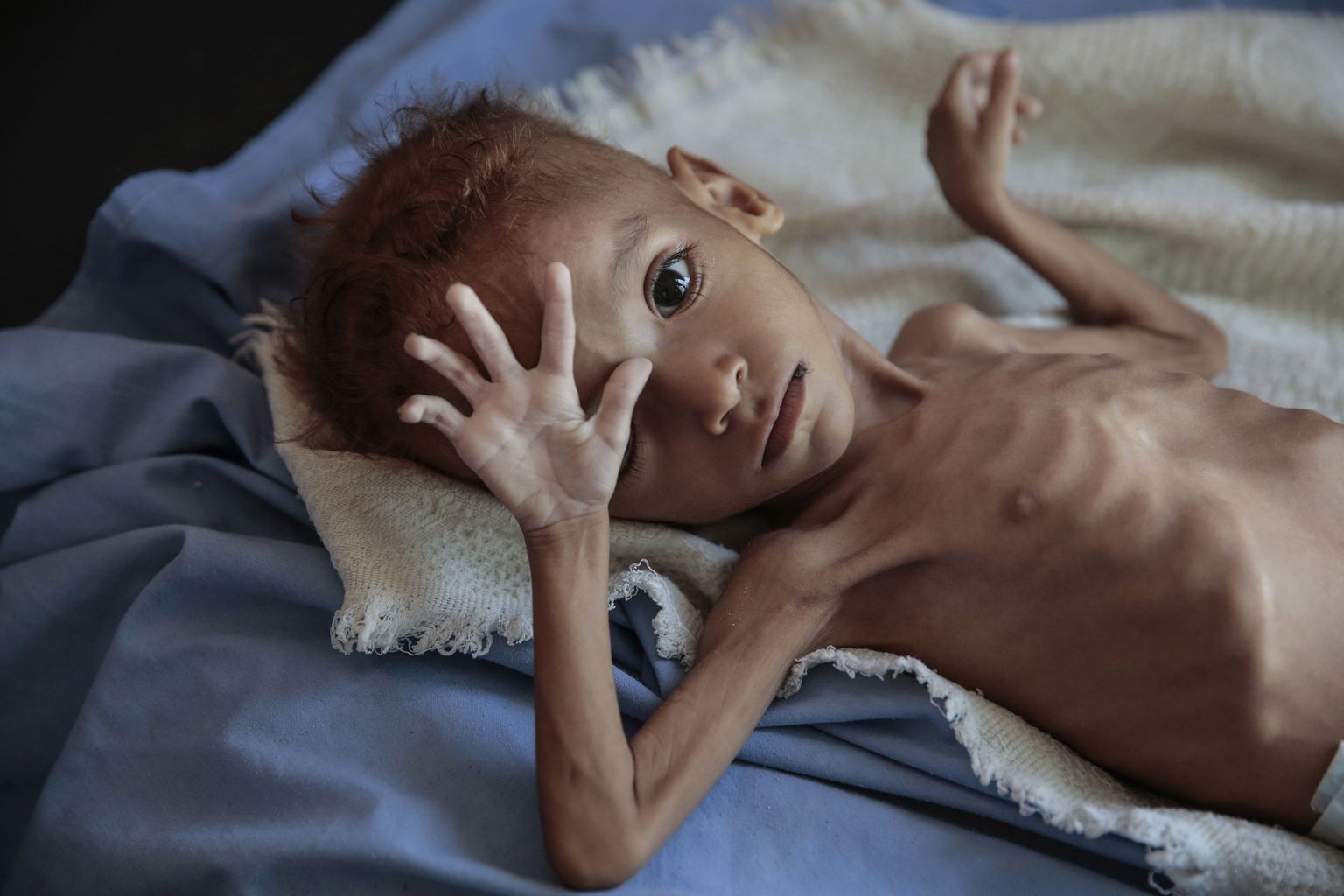 Tõsise alatoitumusega laps Jeemenis.