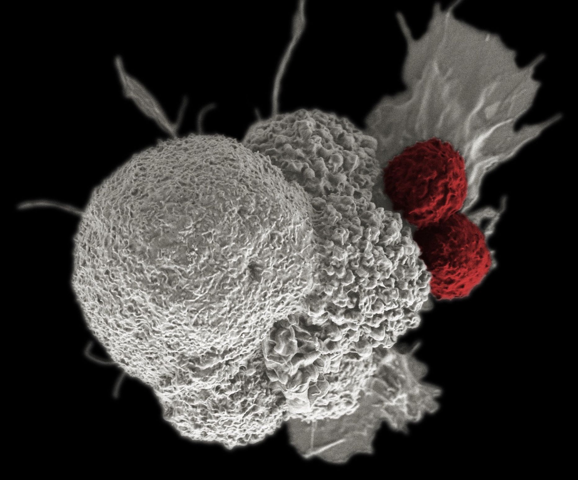Elektronmikrofoto kahest immuunrakust, mis ründavad vähirakku – immuunteraapia on üks lootustanvamaid vähiravivõtteid.