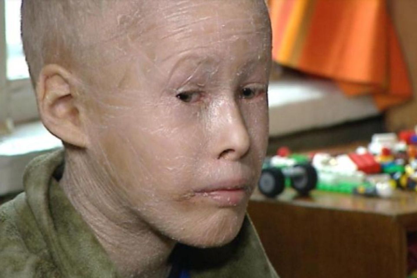 8aastane Valgamaa poiss Kaido, kellel on diagnoositud pärilik ja eluaegne nahahaigus ihtüoos.