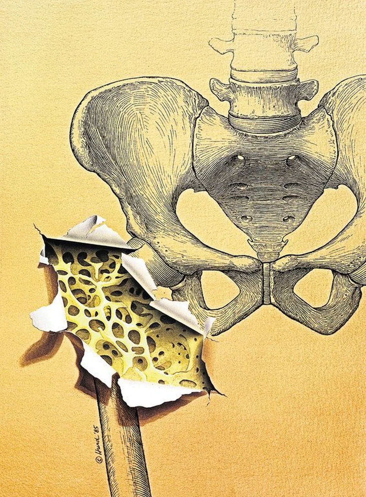 Osteoporoos muudab luud poorseks ja isegi väike trauma võib põhjustada selliste luude murru..