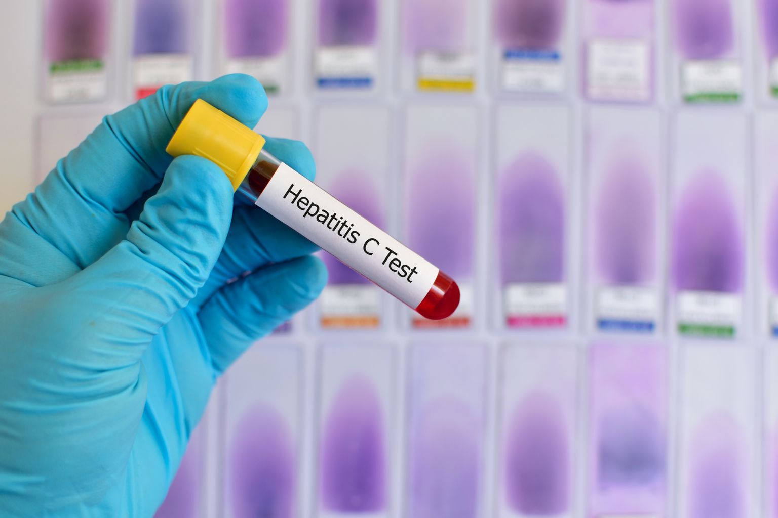 C-hepatiidile pole vaktsiini, kuid selle jaoks on viimastel aastatel välja töötatud tõhus ravi.