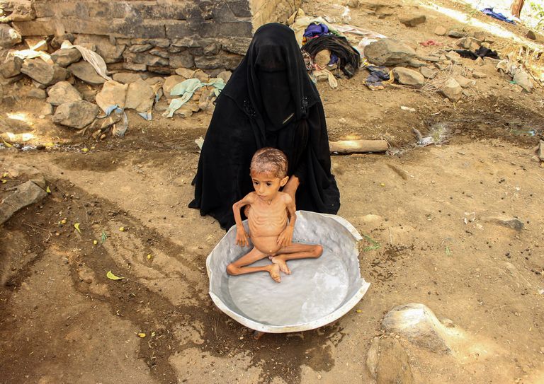 Alatoitumuse käes kannatav poiss Ben Ameri regioonis Jeemenis. 