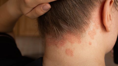 DERMATOLOOG ⟩ 6 ootamatut tegurit, mis võivad psoriaasi ägenemist esile kutsuda