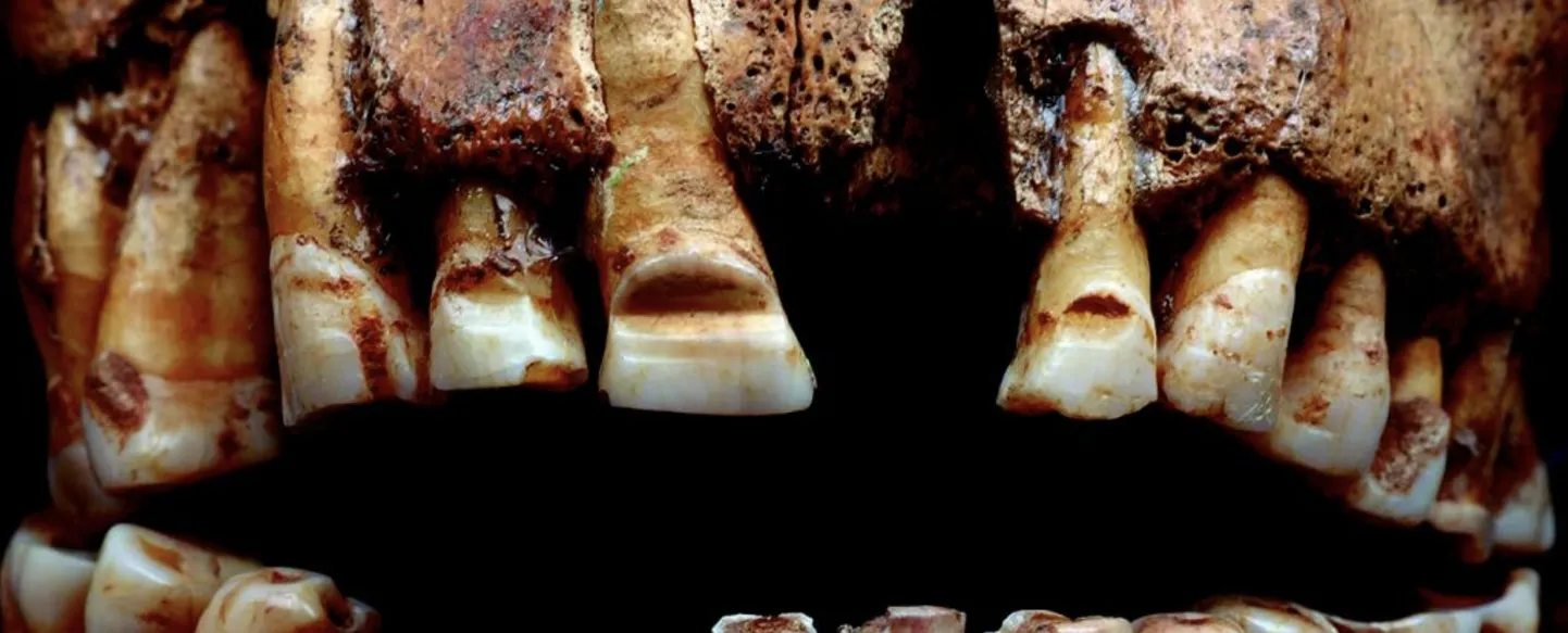 Gotlandile maetud viikingi mehe hammastesse olid viilitud süvendid – arheoloogid arvavad, et see võis olla omaaegne isiku- või tsunftitunnistus.