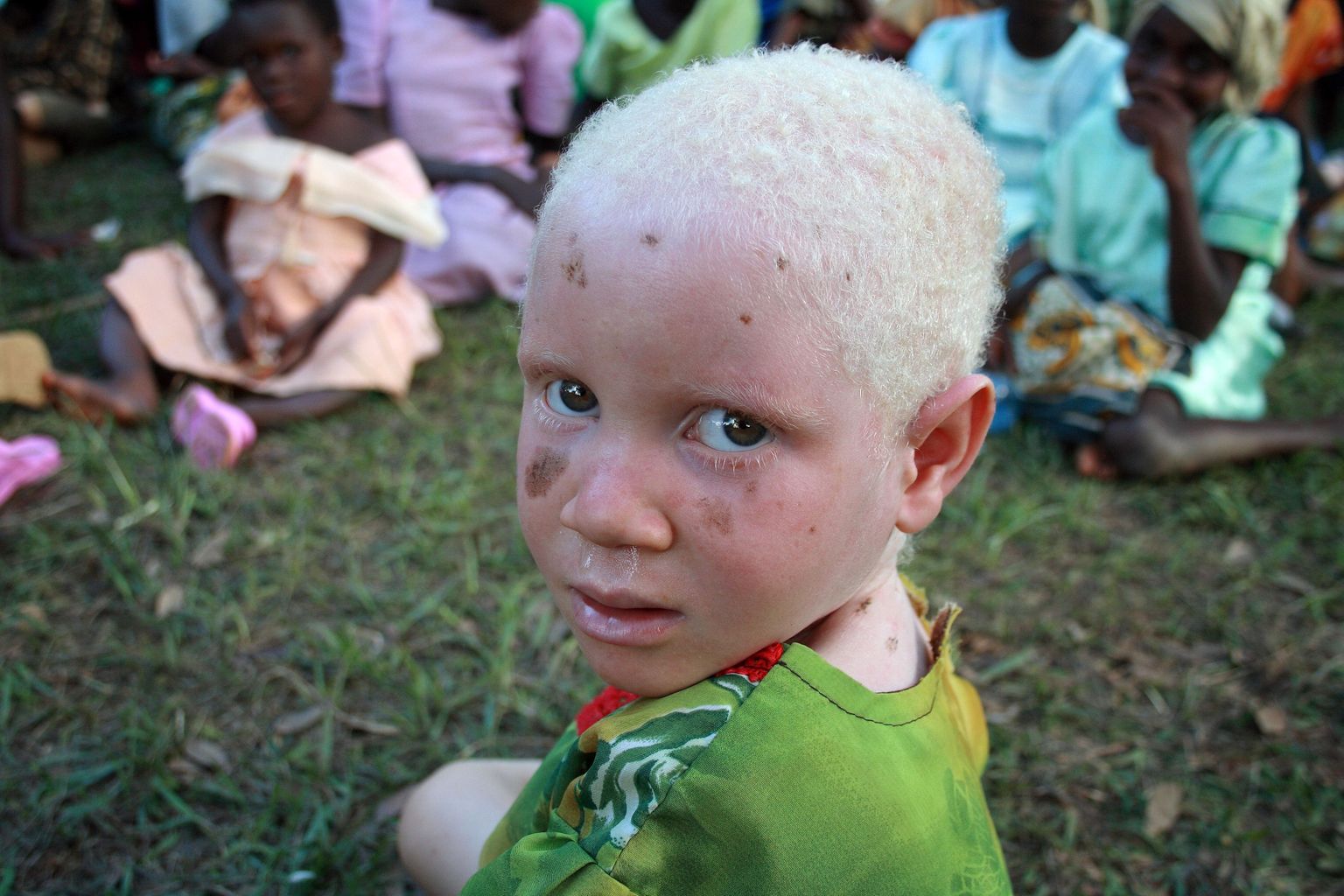 Tansaania albiino laps. Foto on illustratiivne.
