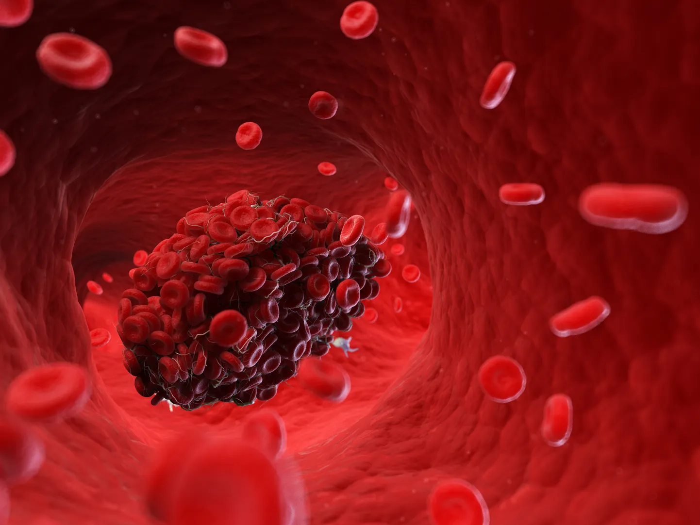 Meditsiiniliselt tõene 3D illustratsioon veresoont ummistavast trombist.